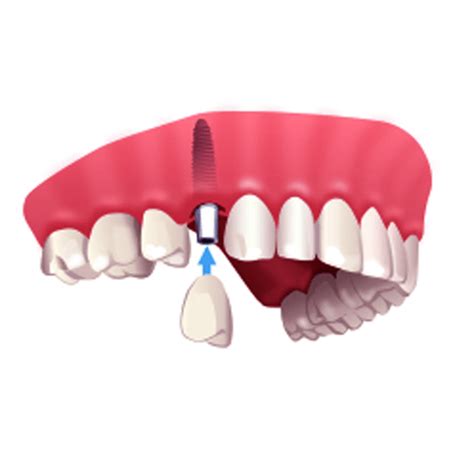 Secure Your Future: Finding Dental School Scholarships